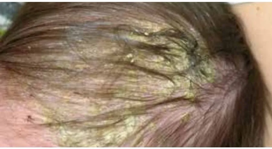 Dermatite Seborroica — immagine 1