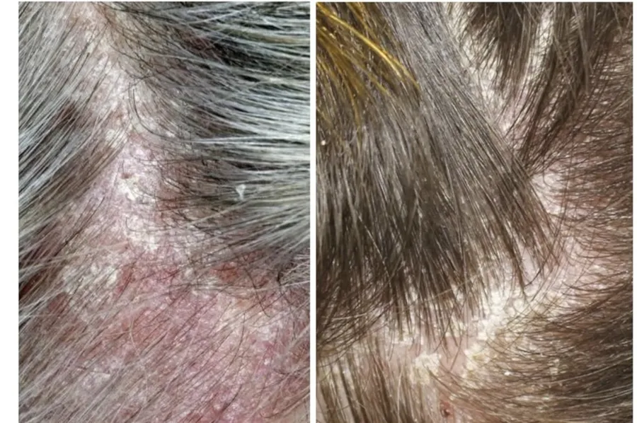 Immagine di Psoriasi al Cuoio Capelluto