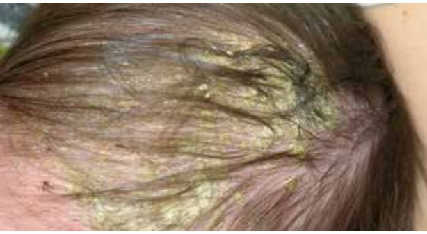 Dermatite Seborroica — immagine 1